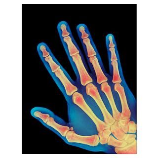 Broken wrist, X ray Poster